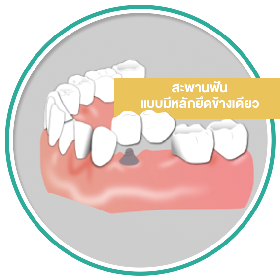 Icon Dental Bridge