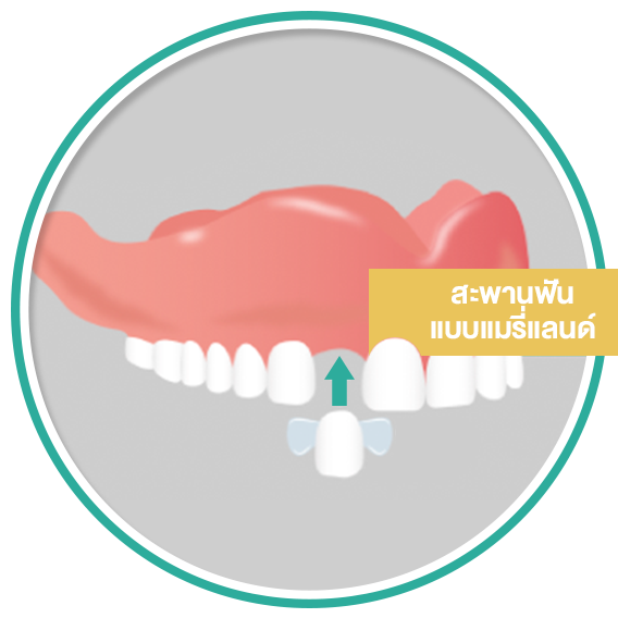 Icon Dental Bridge