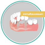 Icon Dental Bridge