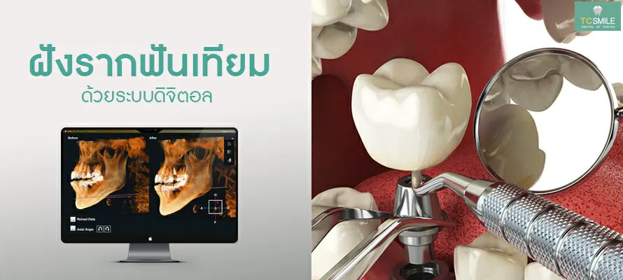 TC-Dental-Implan
