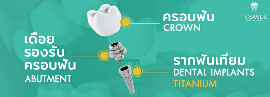TC-Dental-Implant