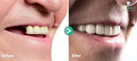 TC-Dental-Implant
