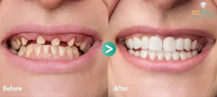 TC-Dental-Implant