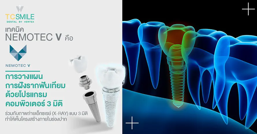 TC-Dental-Implant-Nemotec