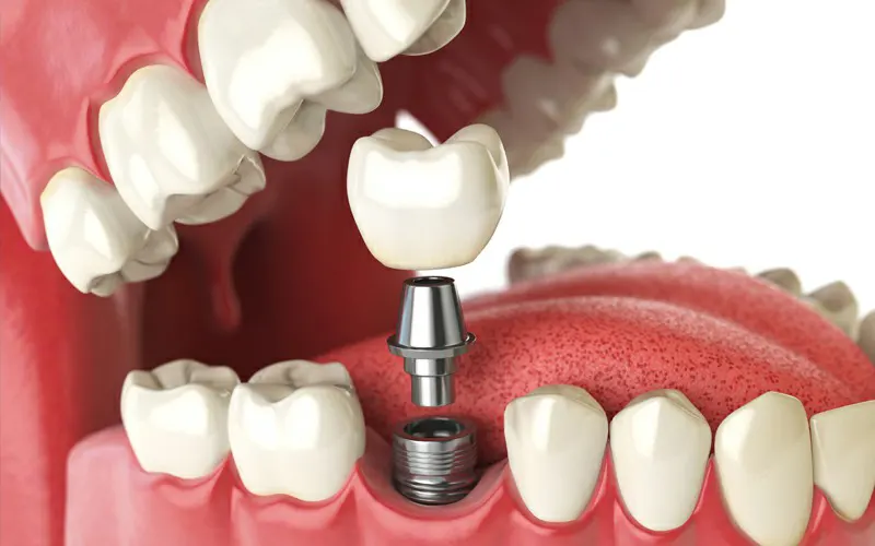 Dental-Implant