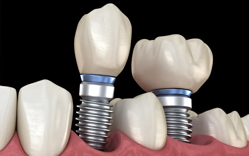 Dental-Implant