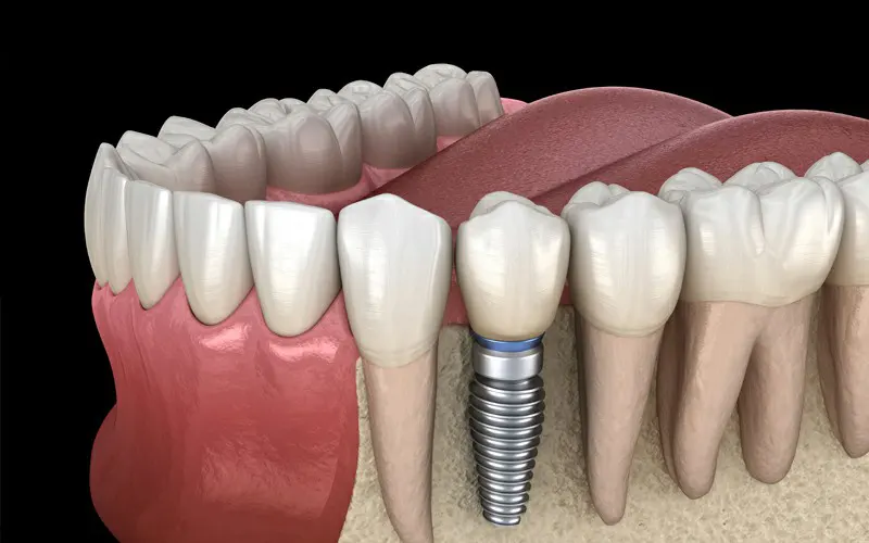 Dental-Implant