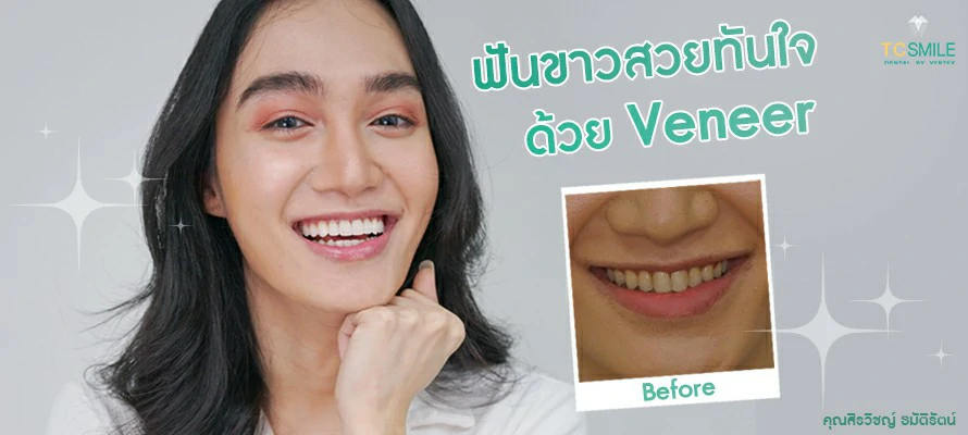 TC-Veneer-Review