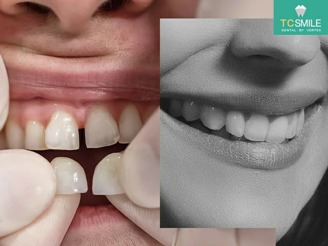 TC-Veneer-Smile-Problem