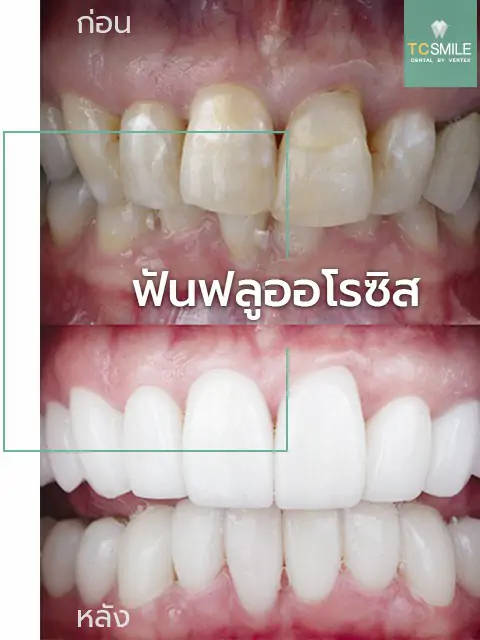 TC-Veneer-Tooth-Problem