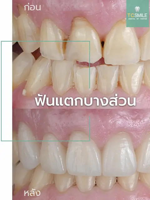 TC-Veneer-Tooth-Problem