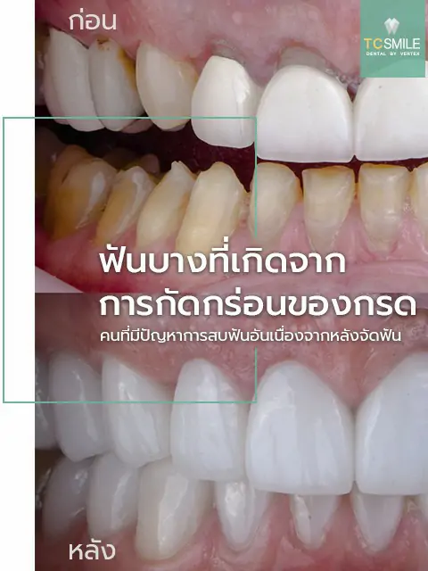 TC-Veneer-Tooth-Problem