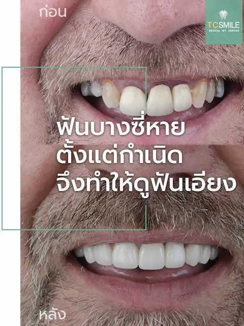 TC-Veneer-Tooth-Problem