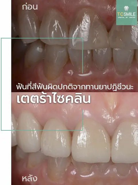 TC-Veneer-Tooth-Problem
