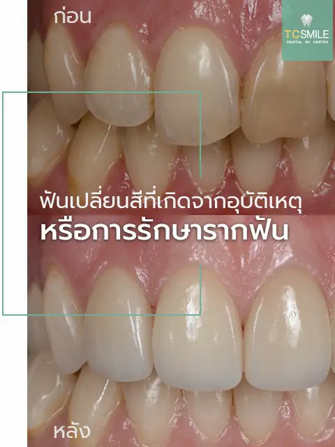 TC-Veneer-Tooth-Problem