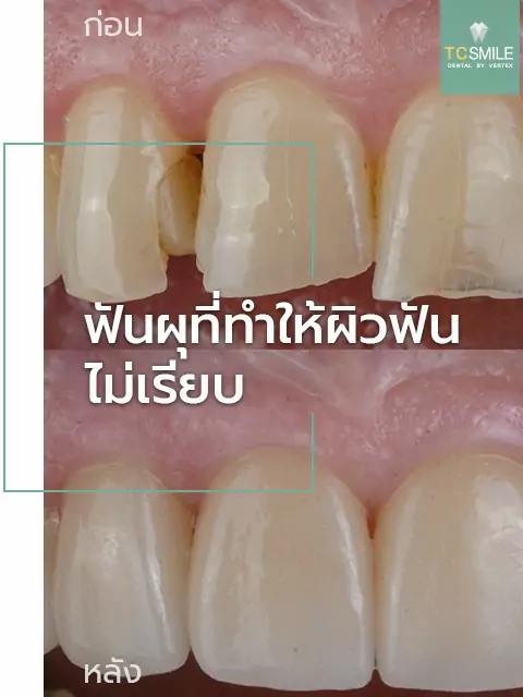 TC-Veneer-Tooth-Problem