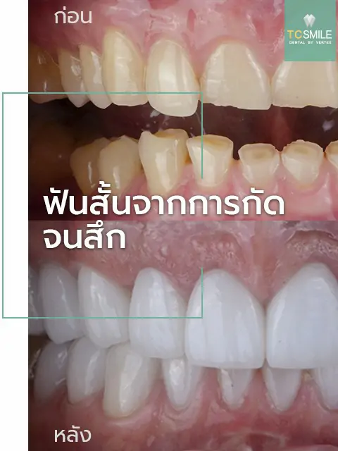TC-Veneer-Tooth-Problem