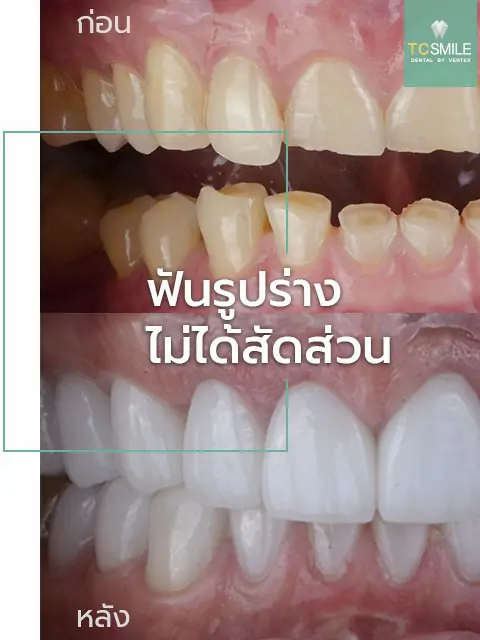 TC-Veneer-Tooth-Problem