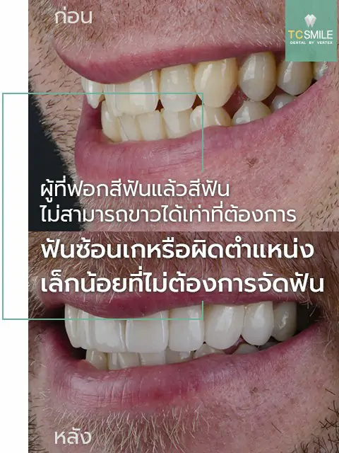 TC-Veneer-Tooth-Problem