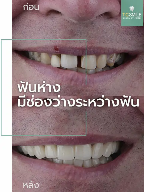 TC-Veneer-Tooth-Problem