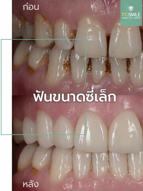TC-Veneer-Tooth-Problem