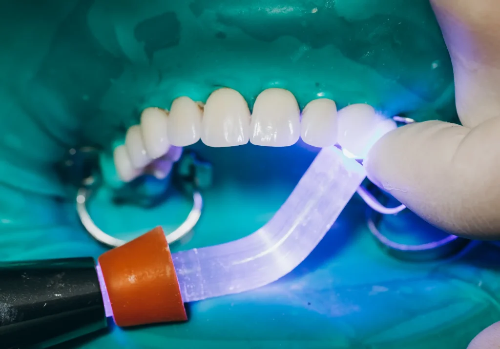 VENEER-white-teeth-beautiful-teeth