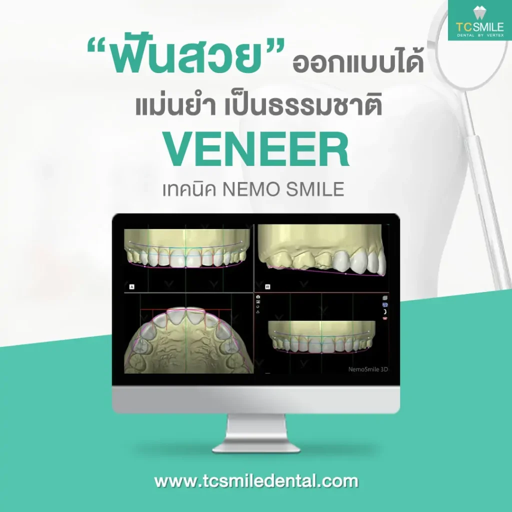 VENEER-white-teeth-beautiful-teeth