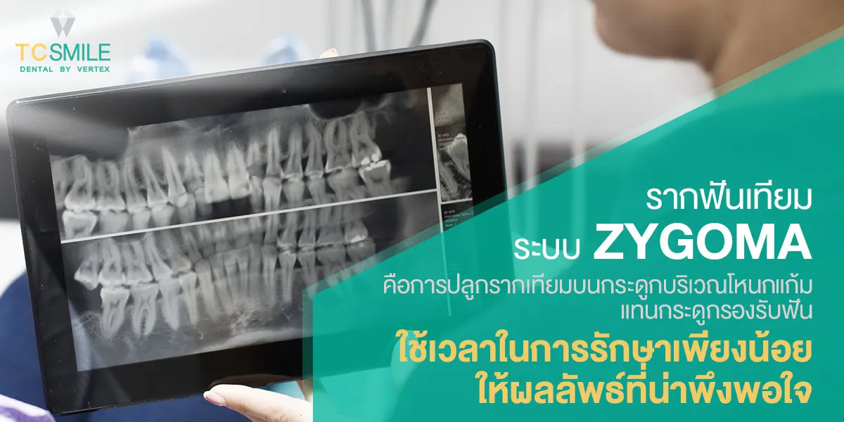 รากฟันเทียม-zygomatic