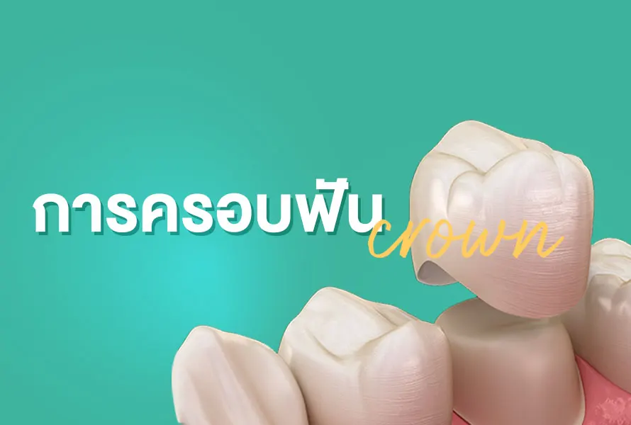 การครอบฟัน-crown