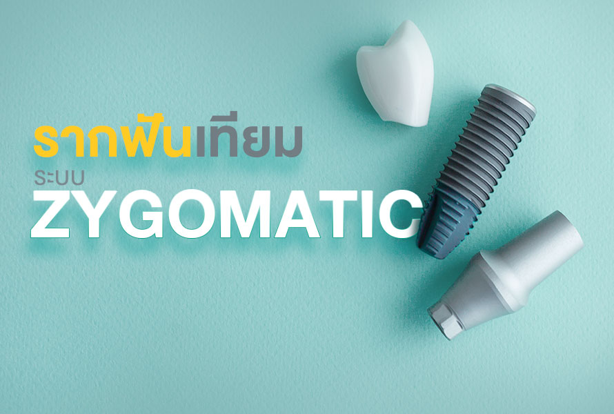 รากฟันเทียม-zygomatic